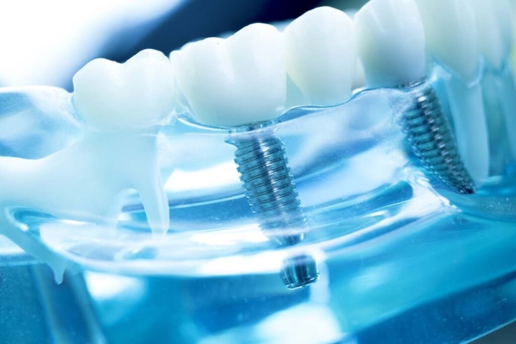 Implants - Pearl Family Dental Care